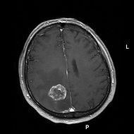 Brain Metastasis From Lung Cancer