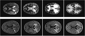 Gene Therapy Gene Therapy