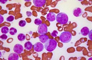 Chronic_myelogenous_leukemia