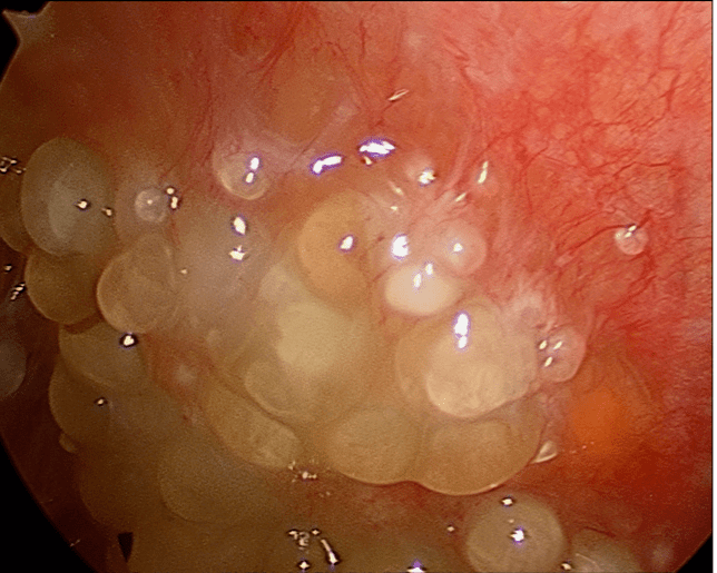 Peritoneal Carcinosis viewed by laparoscopy. Image: www.cancersurgery.us