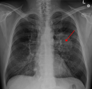 X-ray of a lung cancer patient. Image credit: 