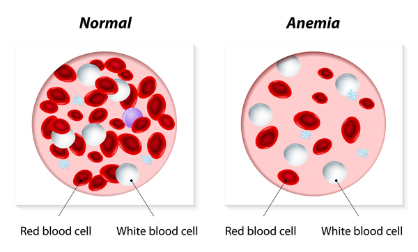 Anemia. Image Credit: NIH