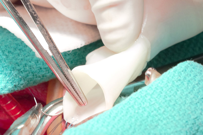 "Researchers are working to create an “off-the-shelf” material that doctors can implant in a patient, and it can grow in the body. This research has the potential to prevent the need for repeated surgeries in some children with congenital heart defects." - Image courtesy of University of Minnesota